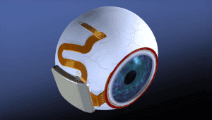 artificial retina implant